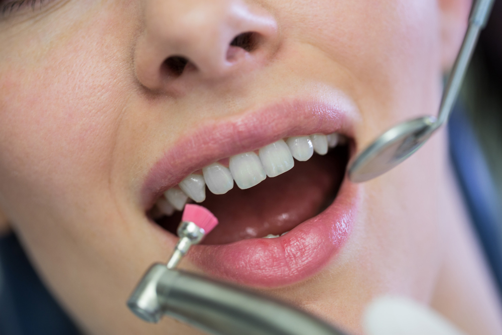 igiene dentale foggia