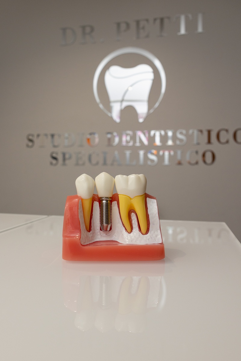 implantologia dentale a foggia